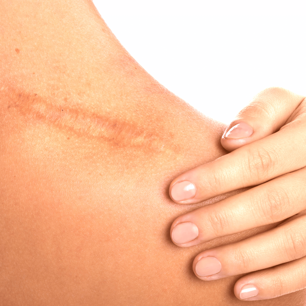 The Best Scar Tissue Massage Tools For The Toughest Scars